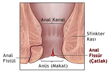 Anal Fissür