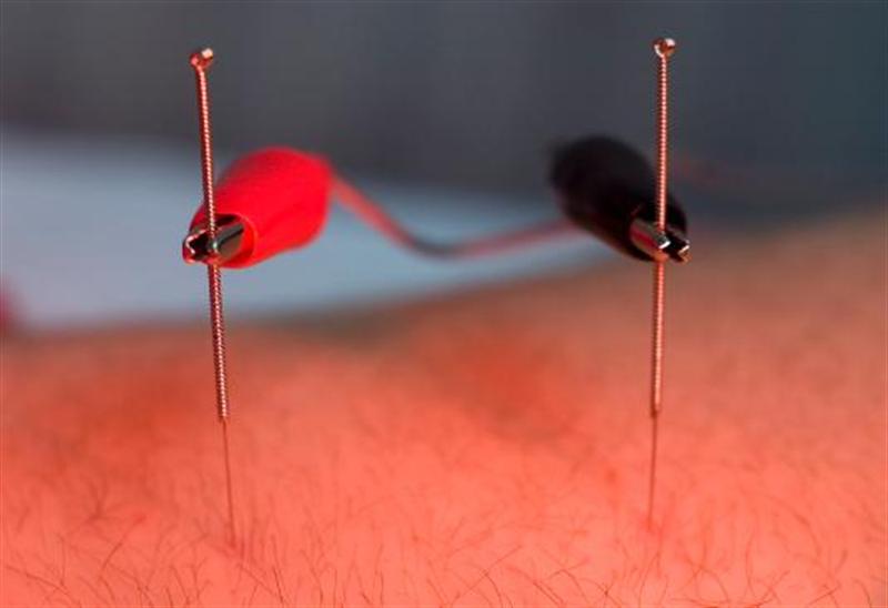 Elektro Akupunktur