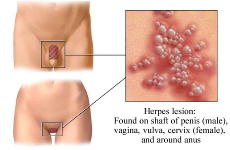 Genital Herpes