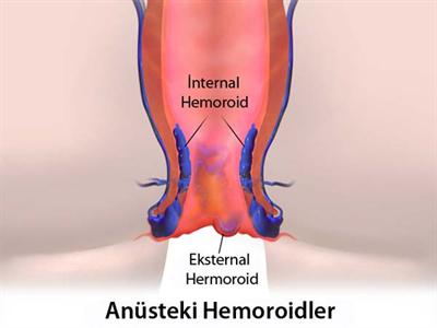 Basur (Hemoroid)