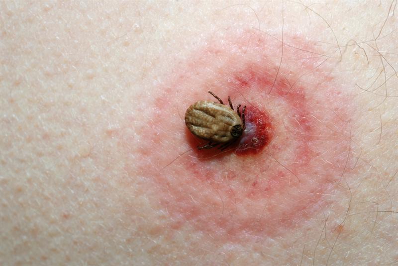 Lyme Hastalığı