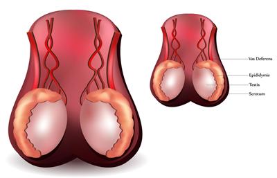 Spermatosel (Epididimal Kist)