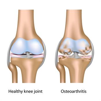 Osteoartrit