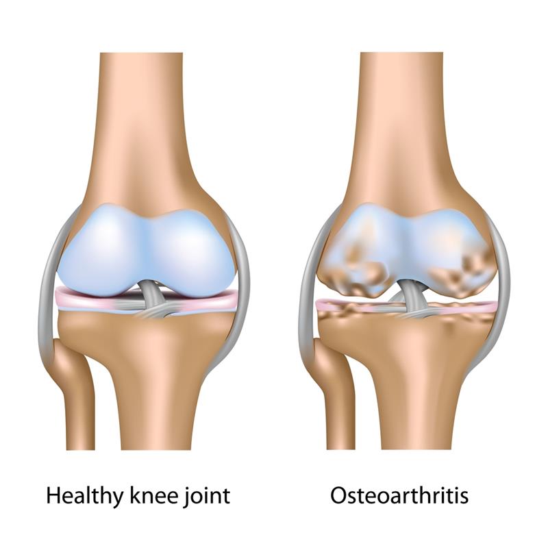 Osteoartrit