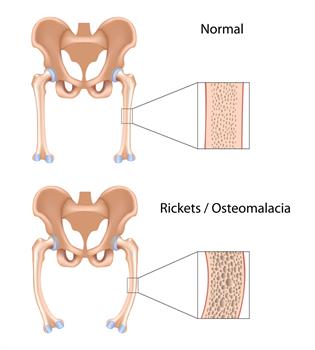 Osteomalazi