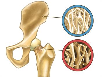 Osteoporoz