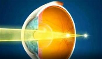 Astigmatizm ve Kontakt Lens