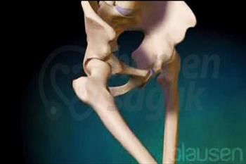 Kalça Osteoartriti